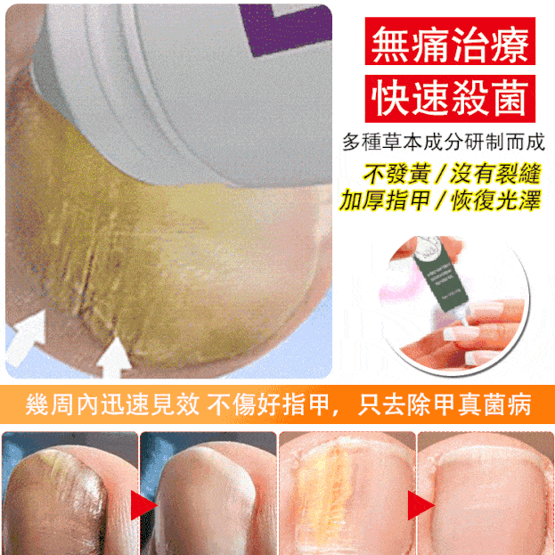 指甲抑菌膏